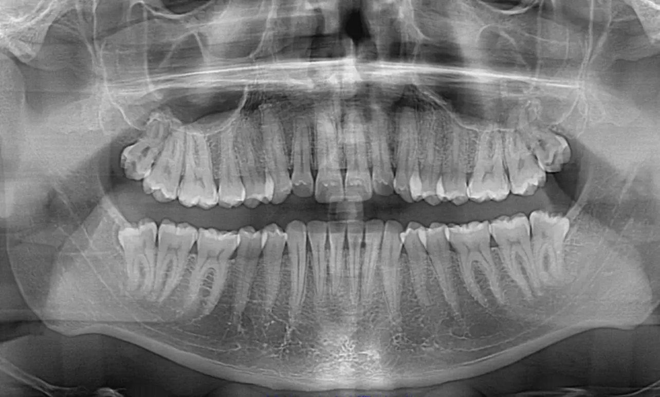 Dr. Santiago Montoya - Exodoncia de extracción